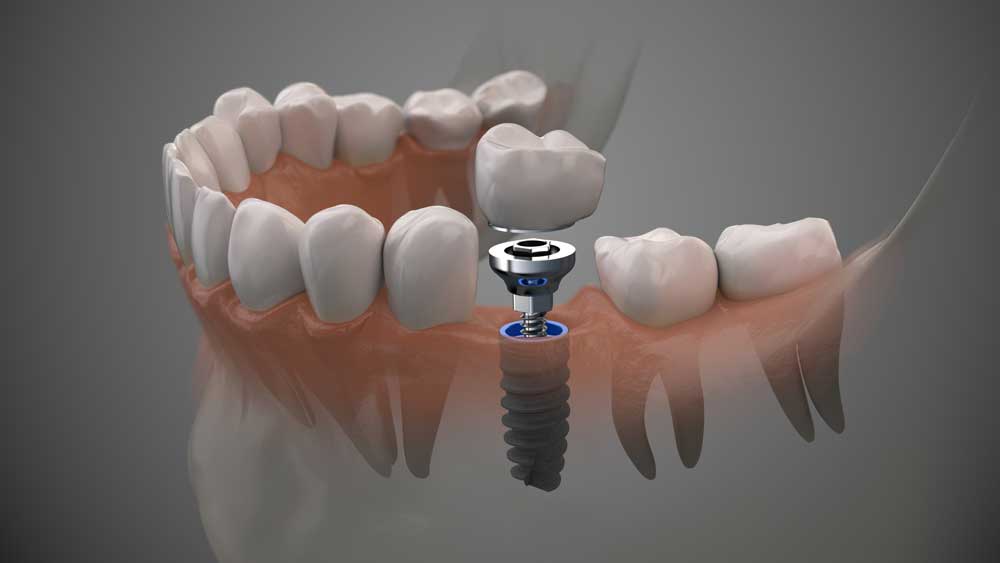 implantes32
